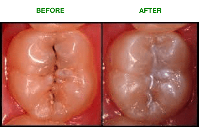 Fissure sealants skye dental services