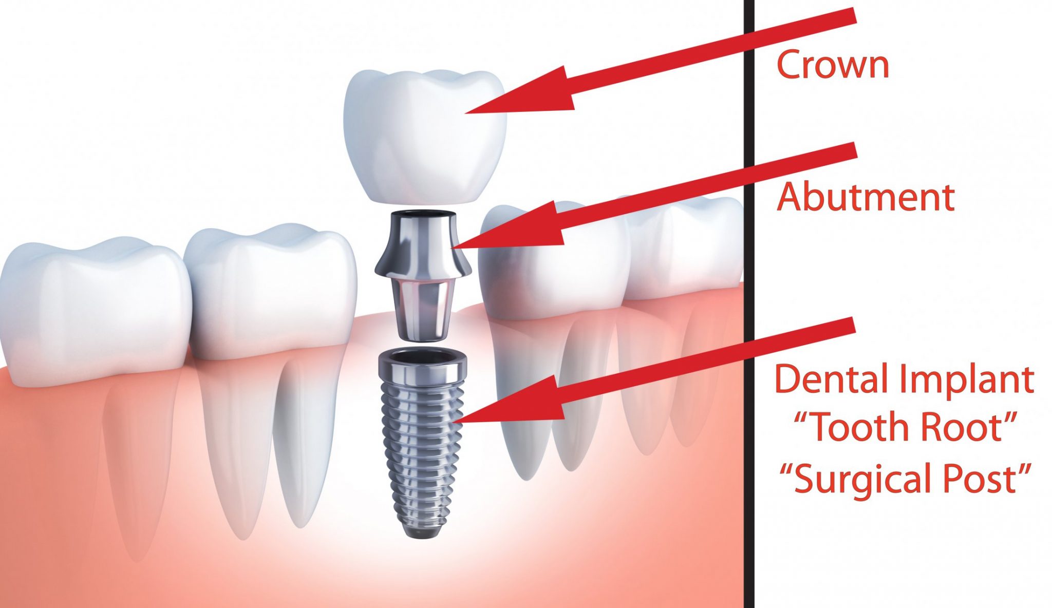 Dental Implant skye dental services